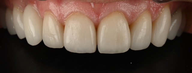 Ceramic Restoration